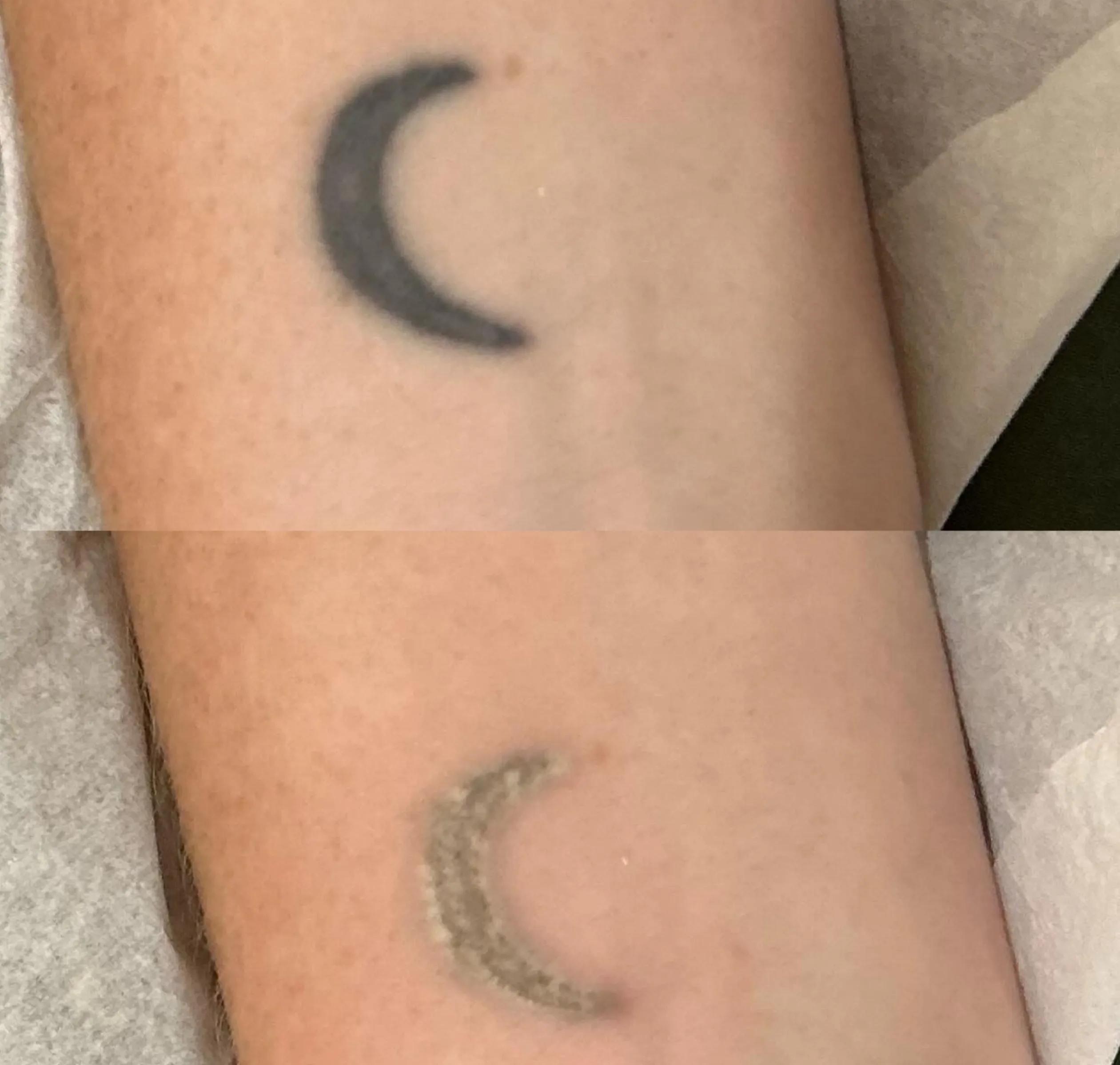 incomplete tattoo removal outcome
