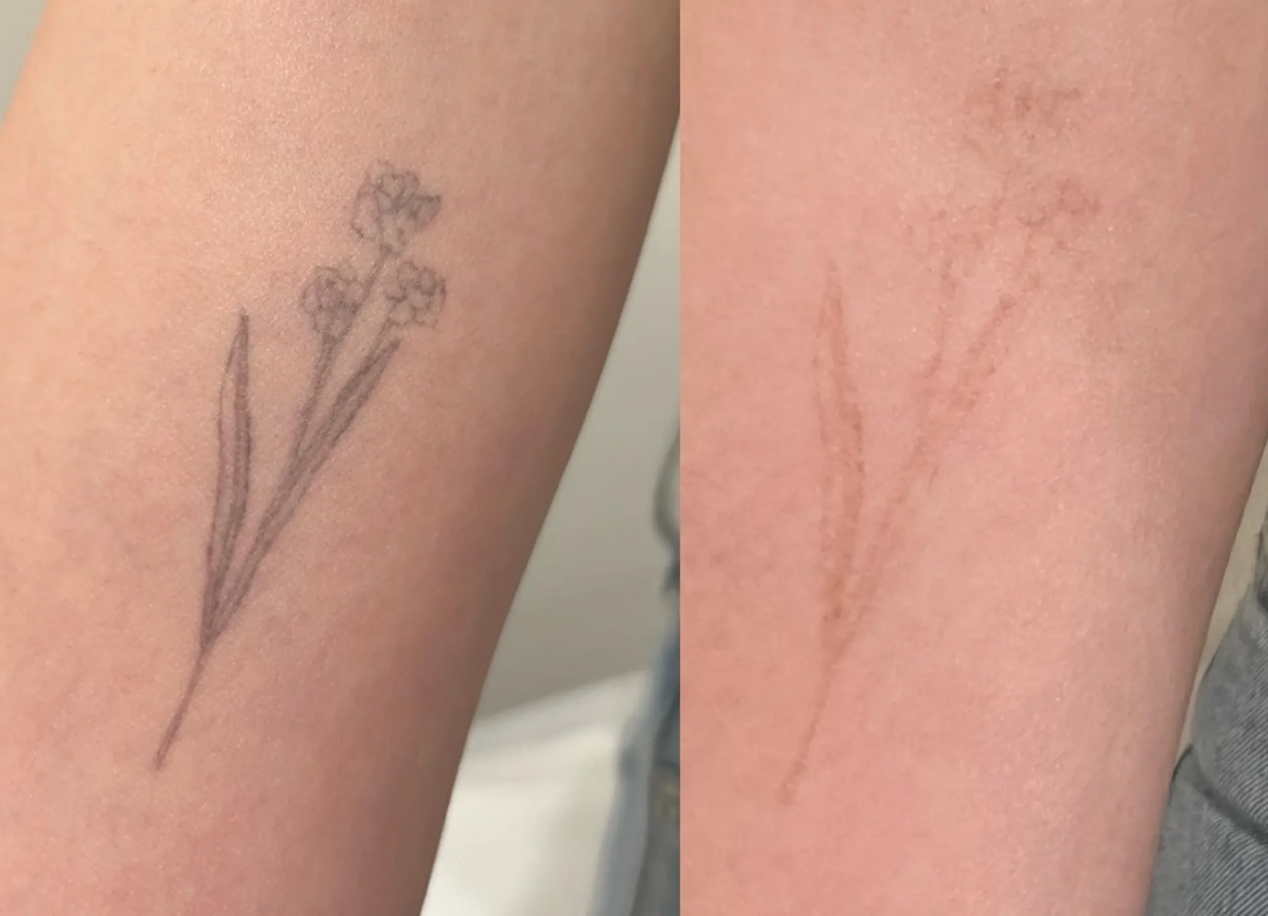 paused laser tattoo removal results