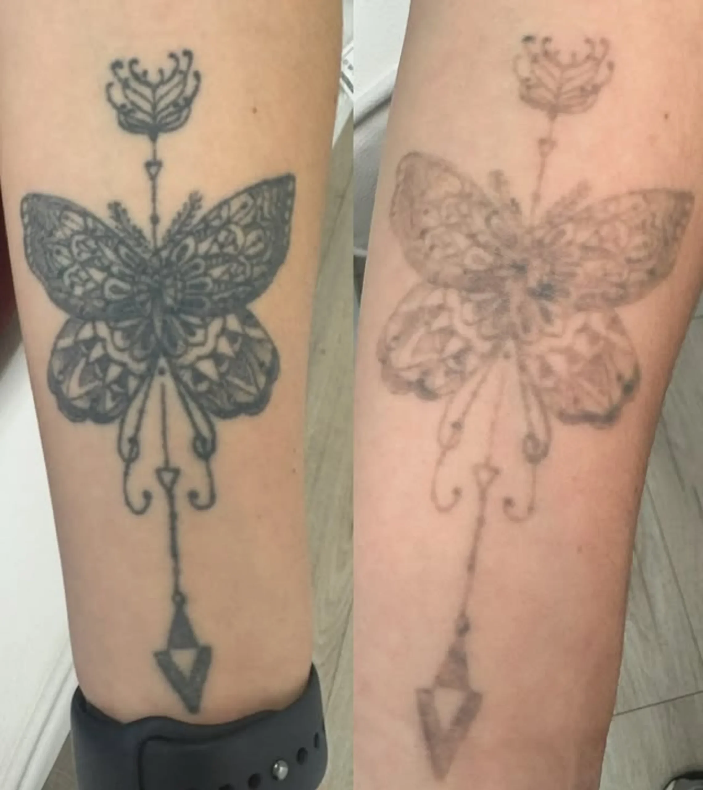 restarting tattoo removal later