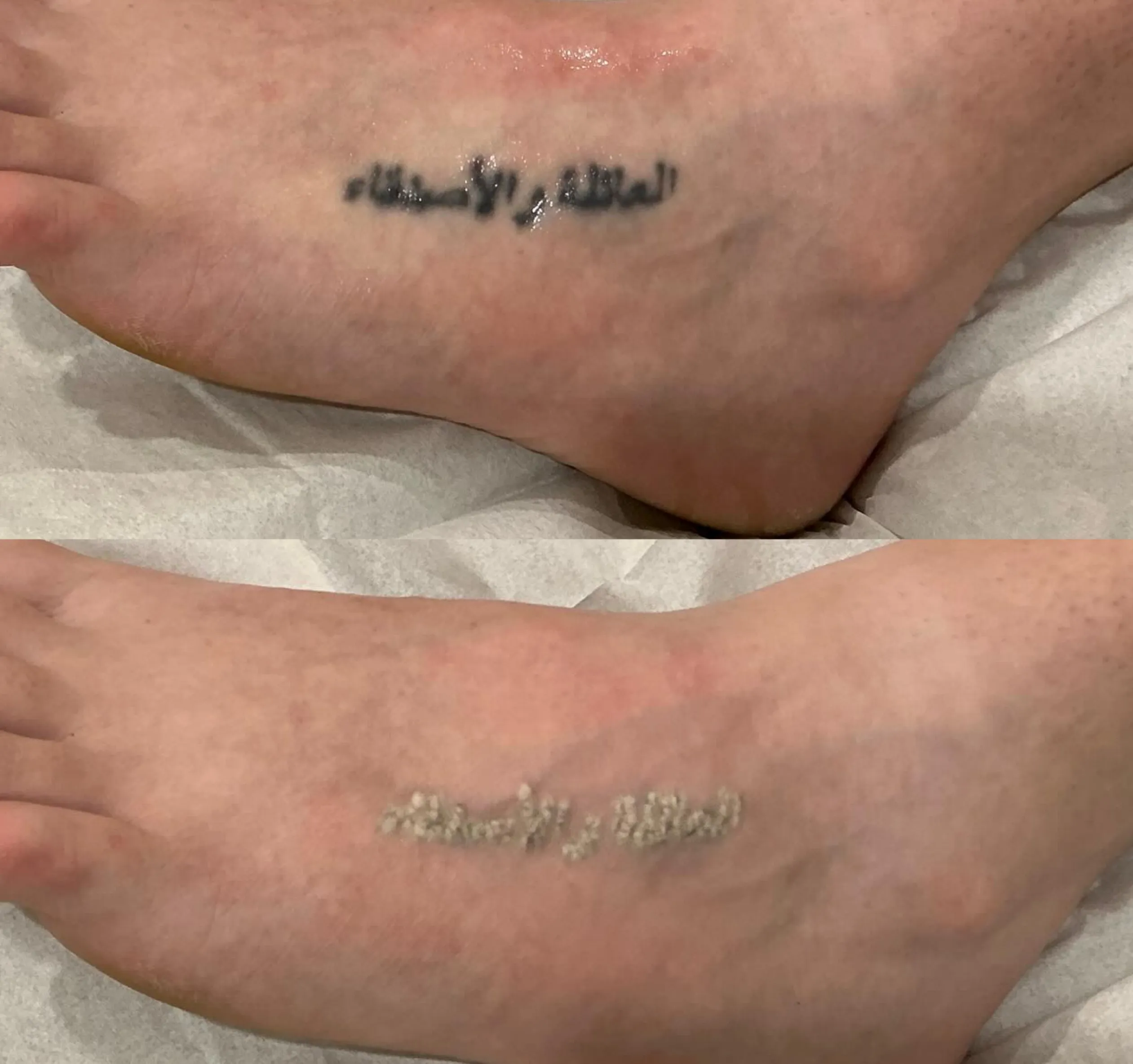 tattoo fading stalls