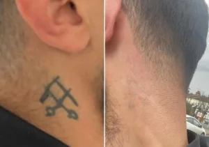 uneven tattoo fading after stopping