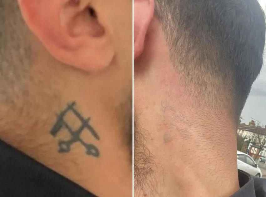 uneven tattoo fading after stopping